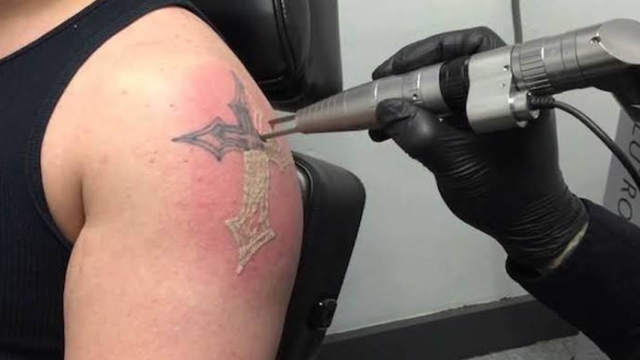 Are Tattoo Removal Creams Safe?