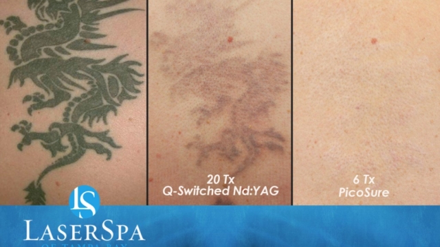 Tattoo Removal – What Is Available For Pain, Cost And Results