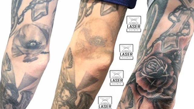 What Is The Most Effective Tattoo Removers?