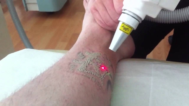 A New Tattoo Ink That Makes Removal Less Painful