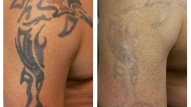 My Tattoo Removal Story